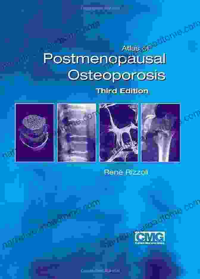 Atlas Of Postmenopausal Osteoporosis, Third Edition Atlas Of Postmenopausal Osteoporosis: Third Edition