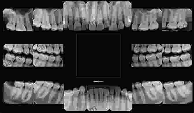 Dental Radiograph Showing A Clear Image Of Teeth Essentials Of Dental Radiography And Radiology E