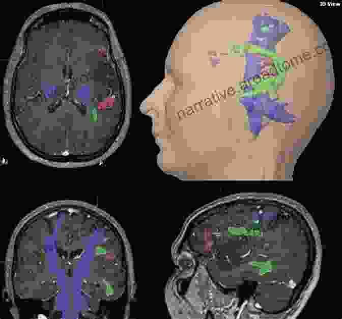 Depiction Of Advanced MRI Techniques, Such As Diffusion Tensor Imaging And Functional MRI MRI For Radiographers Philip T English