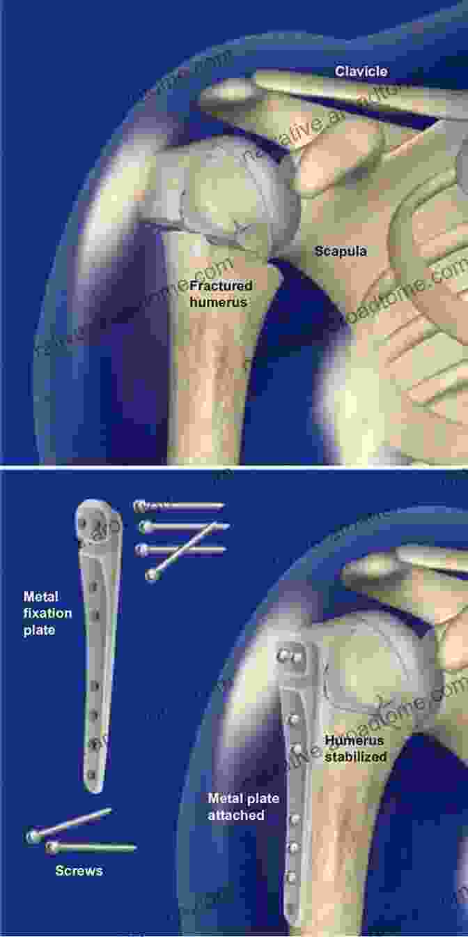 Fracture Management In Orthopedic Surgery Case Competencies In Orthopaedic Surgery