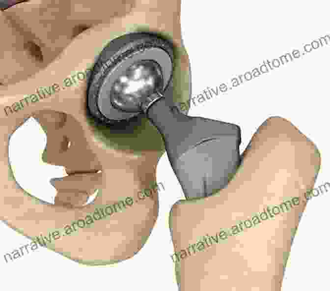 Joint Replacement In Orthopedic Surgery Case Competencies In Orthopaedic Surgery