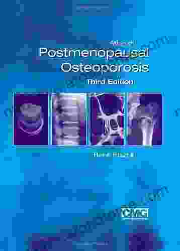 Atlas Of Postmenopausal Osteoporosis: Third Edition