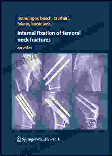 Internal Fixation Of Femoral Neck Fractures: An Atlas